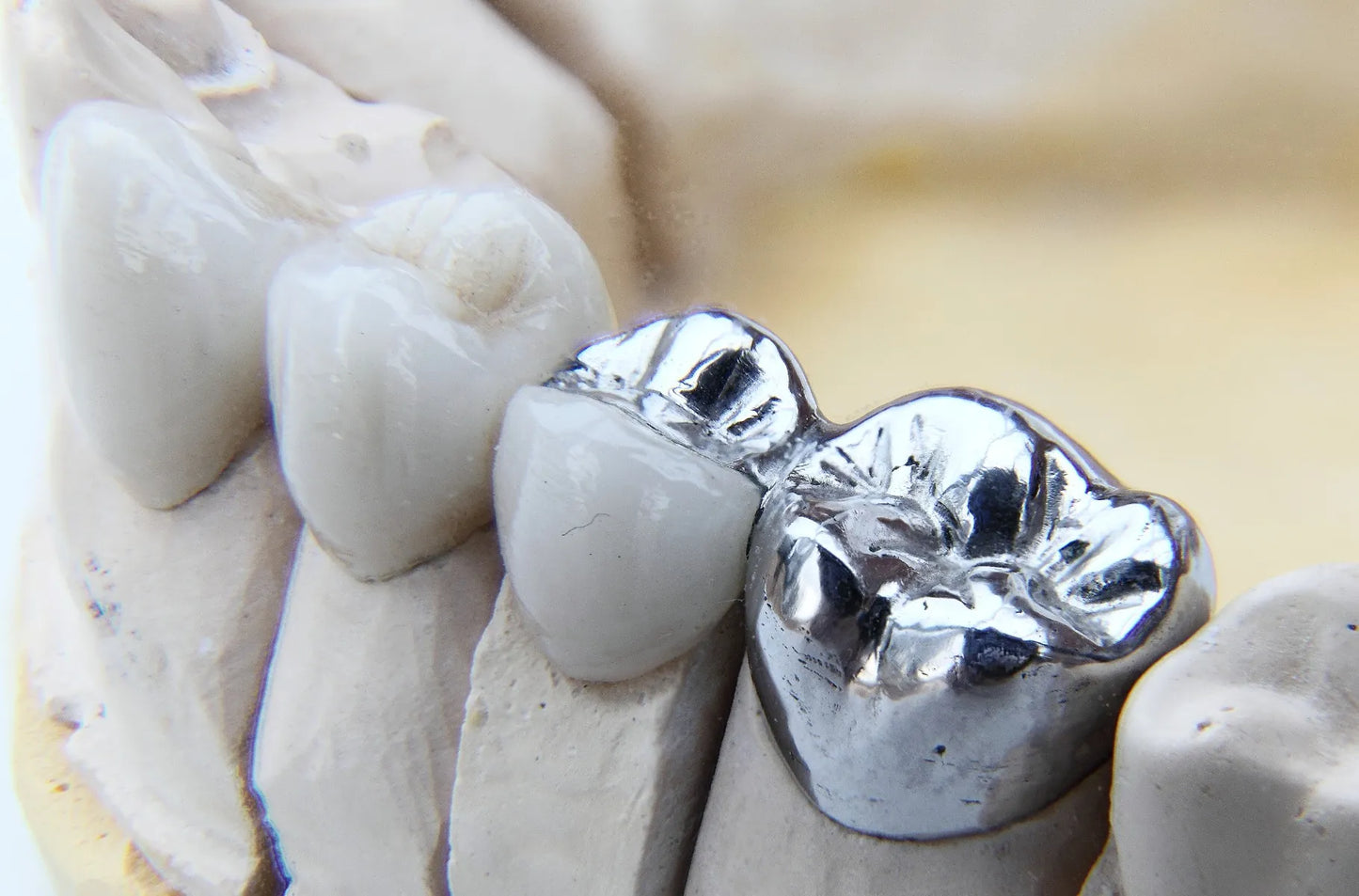 Dentsply StarLoy N Dental Alloy Metal