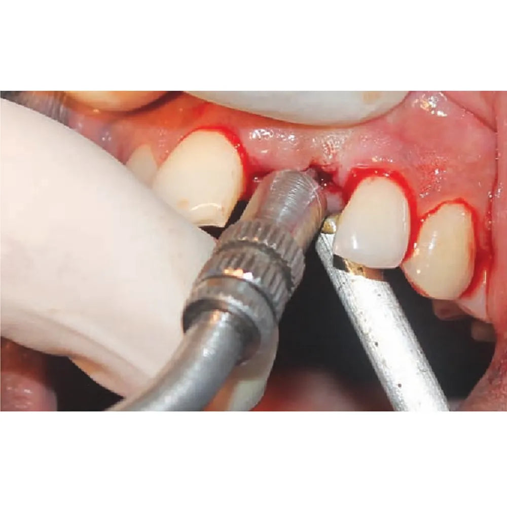GDC Osteotome Concave Angulated Set Of 6 In Pouch (Ostmshsp6)